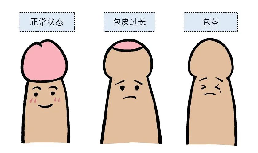 深圳割包皮手術要多長時間恢復